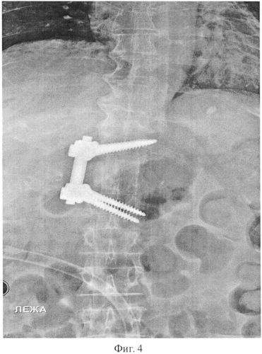 Способ остеосинтеза позвоночника при травмах и заболеваниях (патент 2559275)