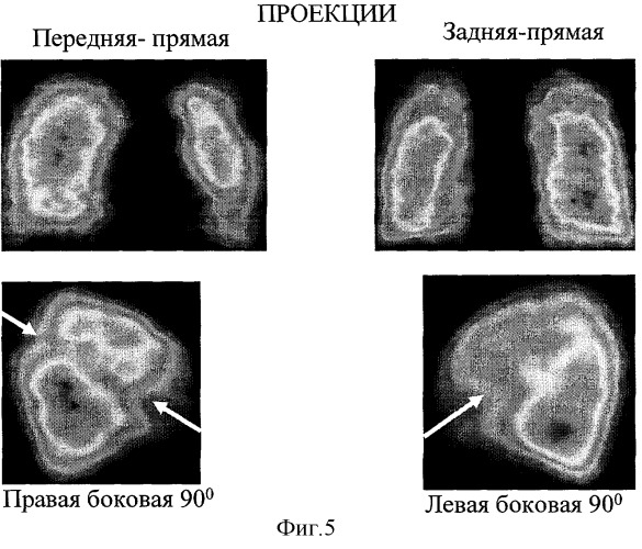 Способ дифференциальной диагностики острых инфекционных заболеваний легких и тромбоэмболий мелких ветвей легочной артерии (патент 2310385)