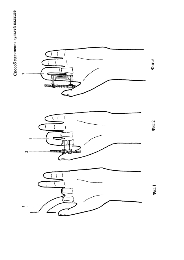 Способ удлинения культей пальцев (патент 2594256)