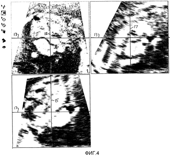 Создание стандартизованных протоколов для анализа данных трехмерной эхограммы (патент 2514112)