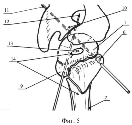 Способ репозиции отломков при закрытом интрамедуллярном остеосинтезе переломов шейки плечевой кости (патент 2513594)