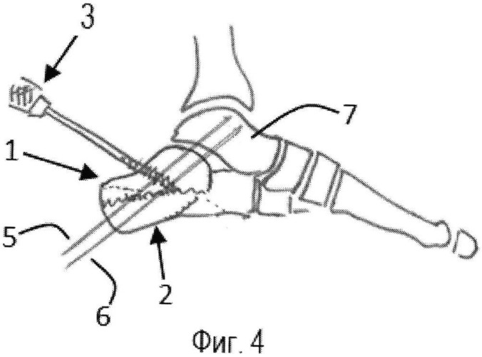 Способ оперативного лечения закрытых оскольчатых языкообразных переломов пяточной кости (патент 2520800)