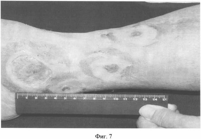 Способ лечения трофических язв нижних конечностей при посттромботической болезни (патент 2328288)