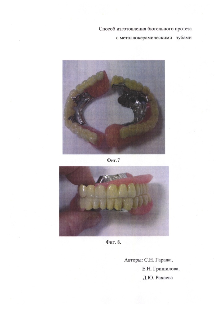 Способ изготовления бюгельного протеза с металлокерамическими зубами (патент 2646127)