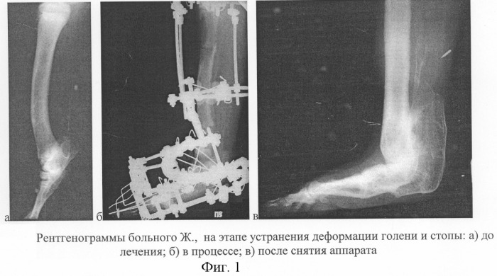 Способ лечения гипоплазии костей голени и стопы, сопровождающейся антекурвационной деформацией дистального отдела большеберцовой кости (патент 2296522)