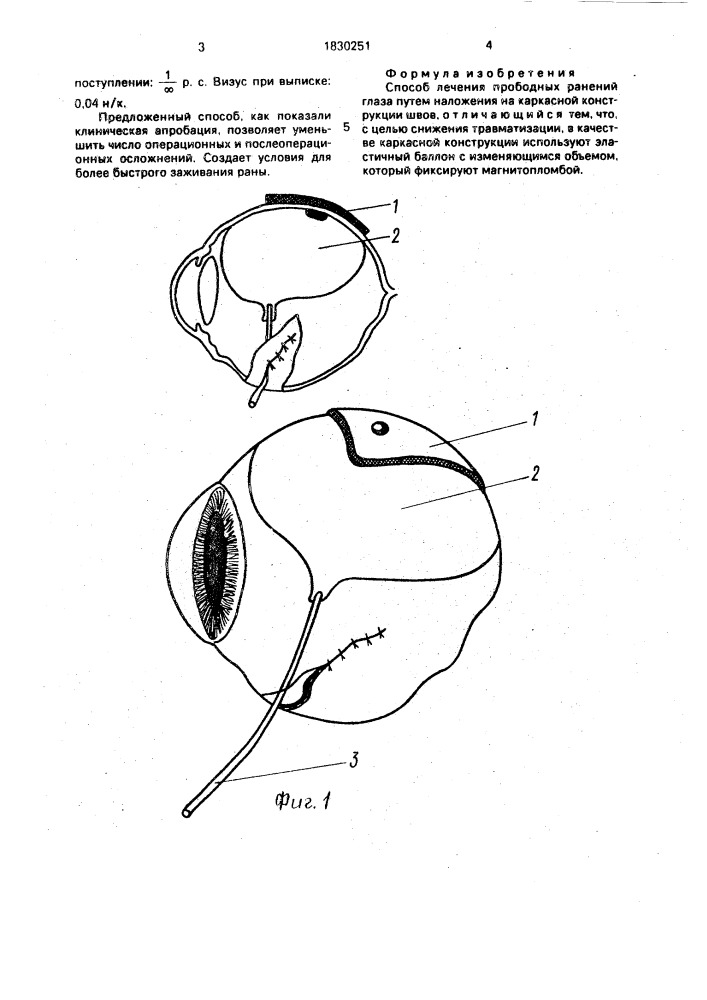 Способ лечения прободных ранений глаза (патент 1830251)