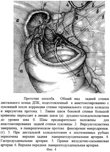 Способ хирургического лечения низких осложненных пенетрацией и кровотечением гигантских дуоденальных язв (патент 2259169)