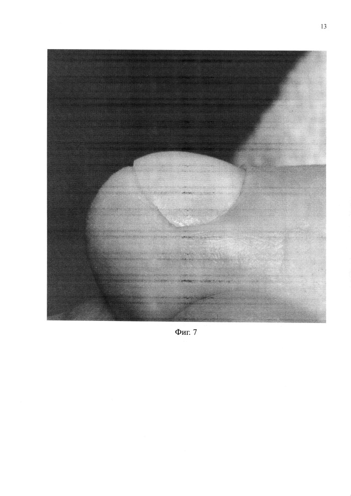 Способ восстановления ногтя (патент 2660991)