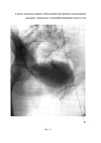Способ эндоваскулярной эмболизации внутренних подвздошных артерий у пациенток с новообразованиями малого таза (патент 2576092)