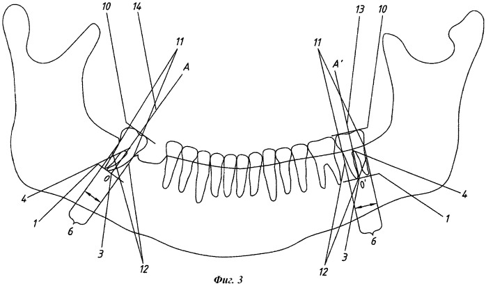 Способ прогнозирования осложнений после протезирования зубов с вторичной адентией (патент 2423912)