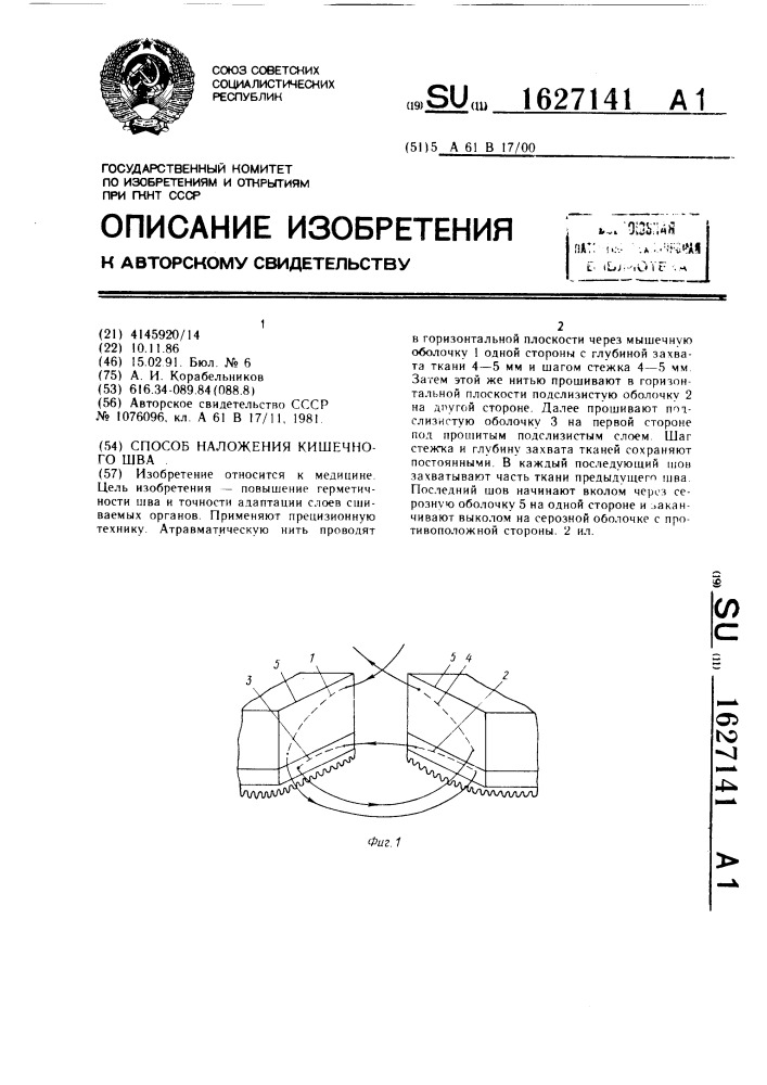 Способ наложения кишечного шва (патент 1627141)