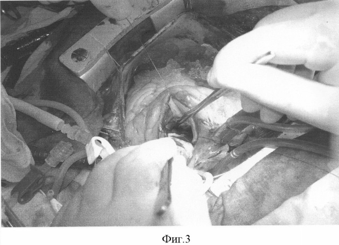 Способ билатеральной аортоаннулопластики при узком фиброзном кольце аорты (патент 2300321)