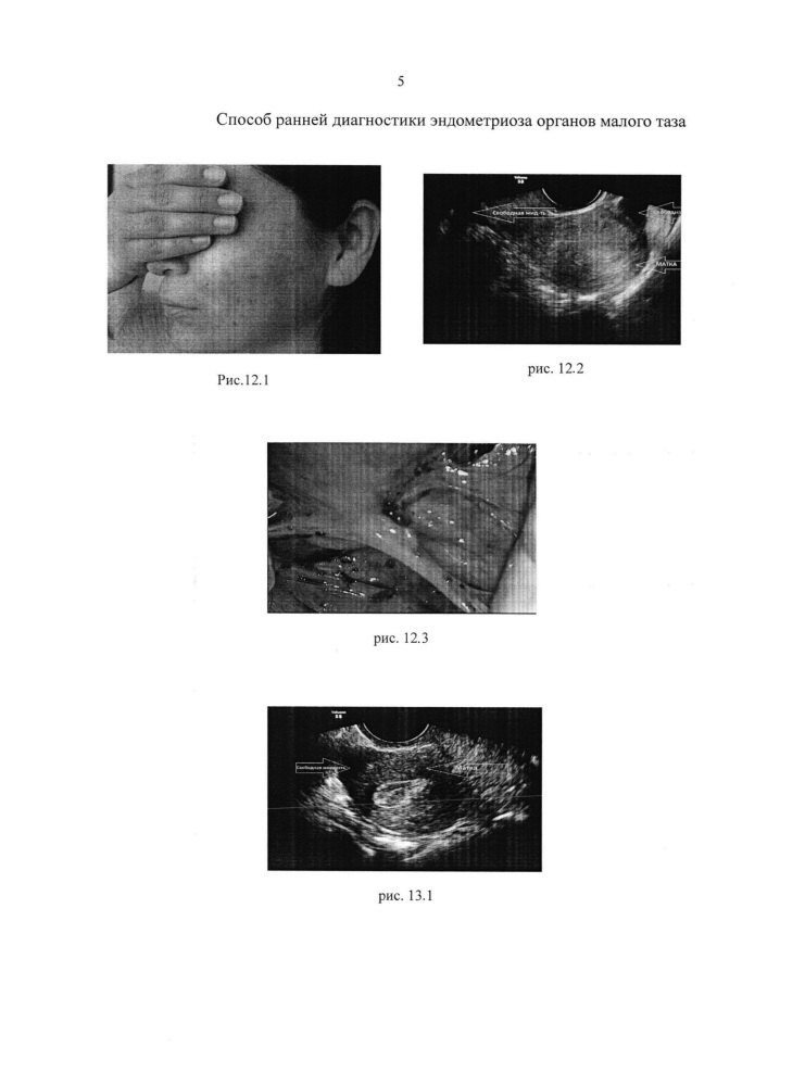 Способ ранней диагностики эндометриоза органов малого таза (патент 2616995)