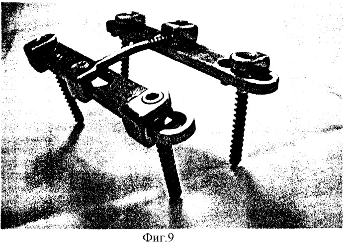 Устройство для заднего спондилодеза (патент 2246279)