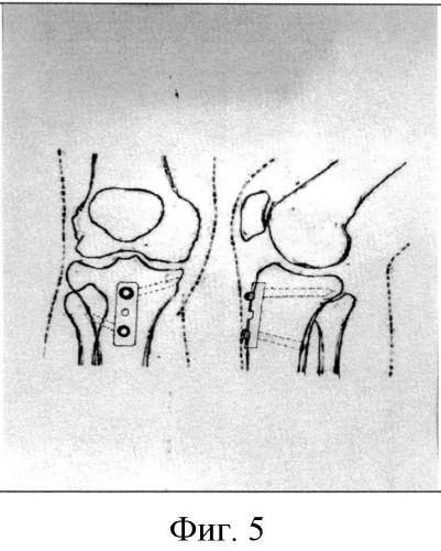 Способ фиксации бугристости большеберцовой кости после ее остеотомии при выполнении доступа к коленному суставу (патент 2558975)