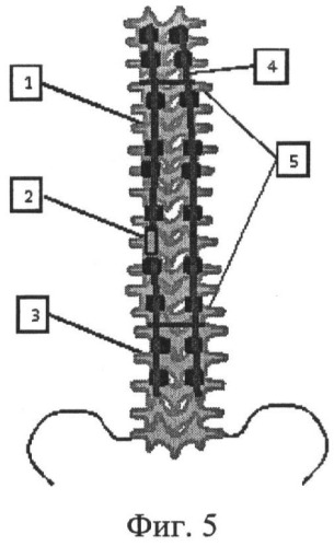 Способ коррекции деформации позвоночника (патент 2506919)