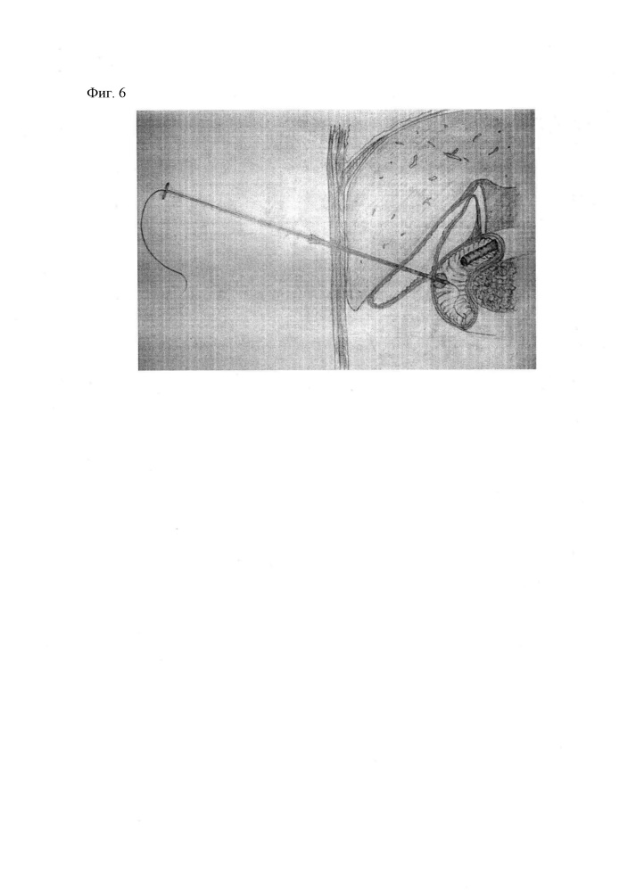 Способ наложения пункционного компрессионного холецистодуоденоанастомоза (патент 2648336)