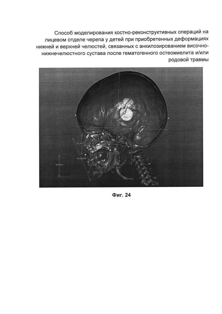 Способ моделирования костно-реконструктивных операций на лицевом отделе черепа у детей при приобретенных деформациях нижней и верхней челюстей, связанных с анкилозированием височно-нижнечелюстного сустава после гематогенного остеомиелита и/или родовой травмы (патент 2604774)
