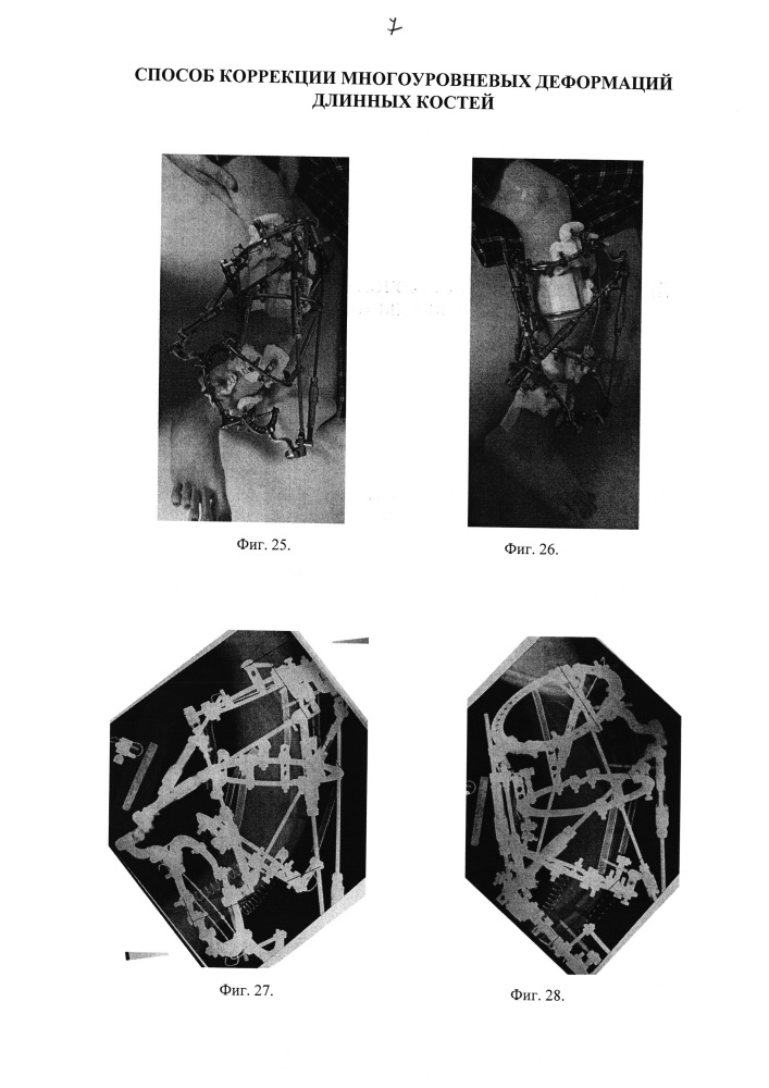Способ коррекции многоуровневых деформаций длинных костей (патент 2640999)