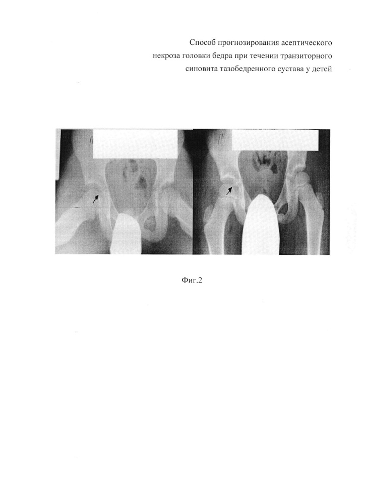 Способ прогнозирования асептического некроза головки бедра при течении транзиторного синовита тазобедренного сустава у детей (патент 2629052)
