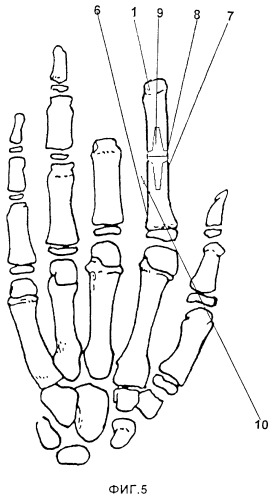 Способ эндопротезирования культей пальцев кисти (патент 2410049)