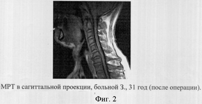 Способ оценки результатов лазерной увулопалатопластики у пациентов с феноменом храпа (патент 2301620)