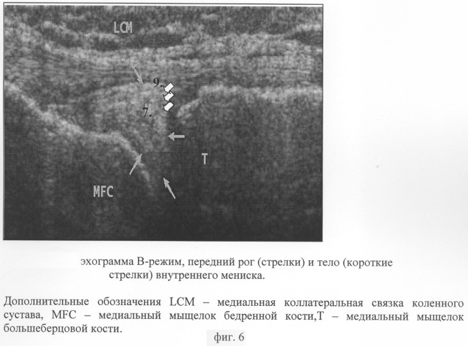 Способ комплексной ультразвуковой диагностики повреждения внутреннего мениска коленного сустава в области тела и переднего рога (патент 2305493)