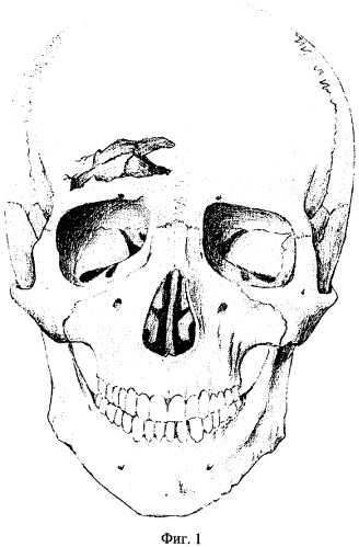Способ лечения закрытых вдавленных переломов лицевой стенки лобных пазух (патент 2308245)