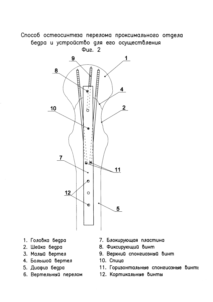 Способ блокируемого остеосинтеза проксимальных переломов бедра и устройство для его осуществления (патент 2595090)