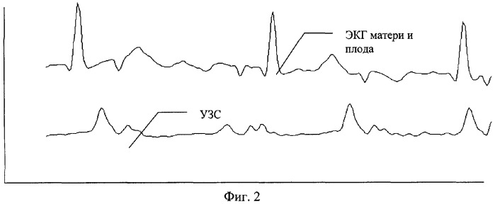 Устройство диагностики состояния плода в дородовый период (патент 2353290)