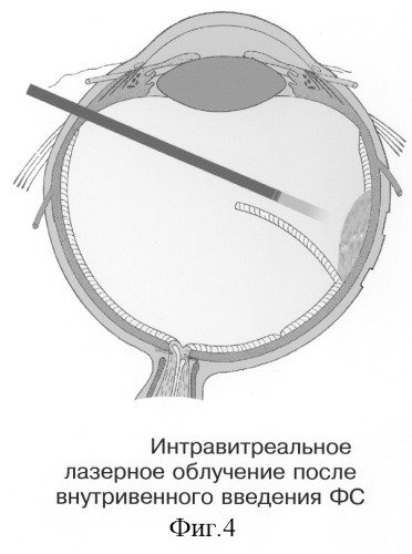 Способ электрохимической деструкции, хирургического удаления и фотодинамической профилактики рецидивов внутриглазных новообразований (варианты) (патент 2244531)