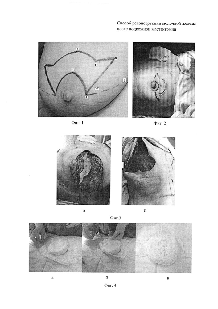 Способ реконструкции молочной железы после подкожной мастэктомии (патент 2653803)