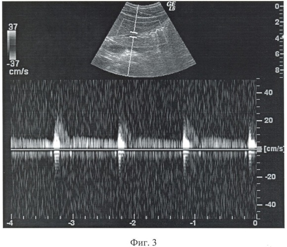 Способ дуплексного сканирования левой желудочной артерии (патент 2393770)