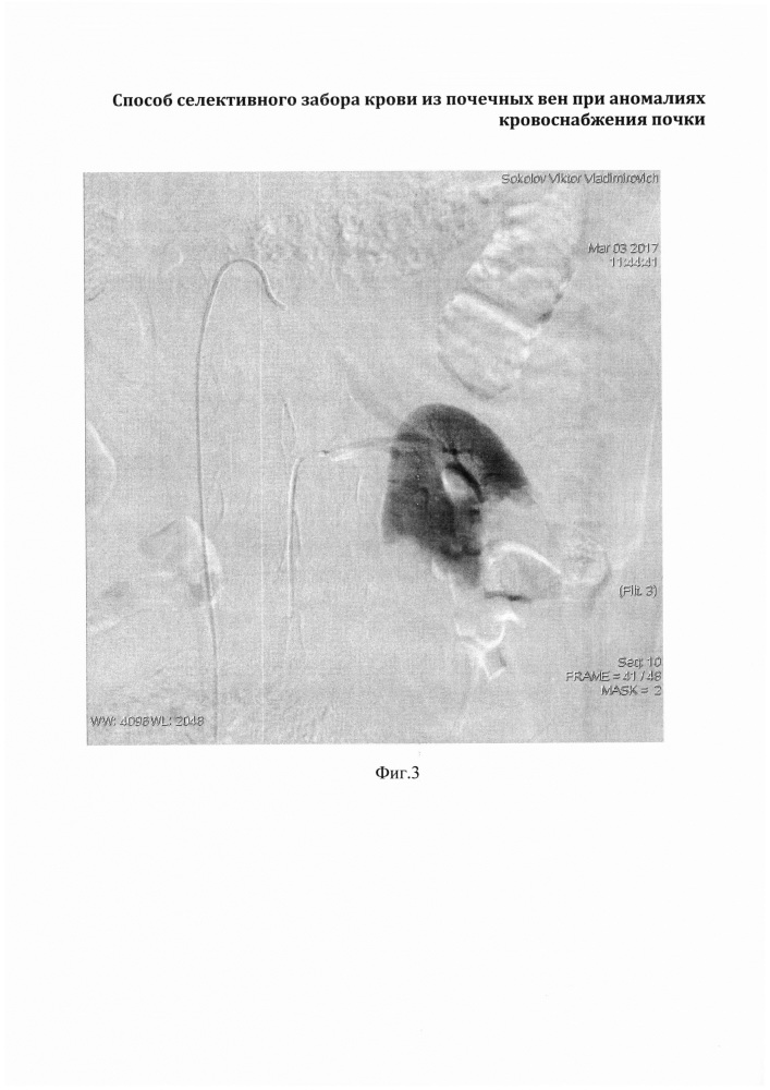 Способ селективного забора крови из почечных вен при аномалиях кровоснабжения почки (патент 2657933)