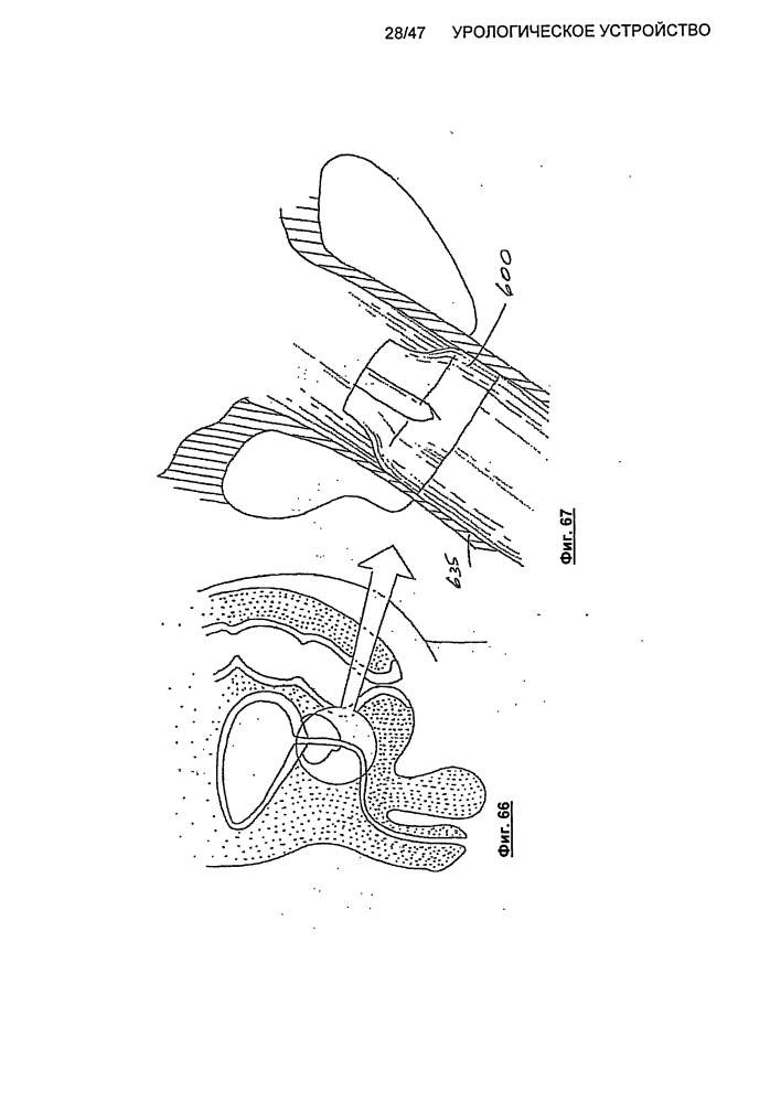 Урологическое устройство (патент 2600865)