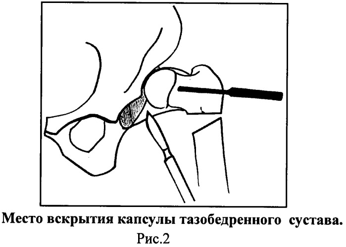 Способ хирургического лечения вывиха бедра у детей (патент 2502486)