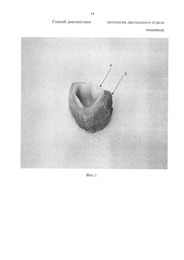 Способ оценки состояния дистального отдела пищевода после проведенного лечения (патент 2598468)