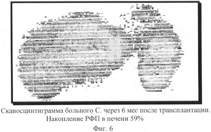 Биотрансплантат, способ лечения хронических заболеваний печени и способ лечения цирроза печени и портальной гипертензии (патент 2368384)