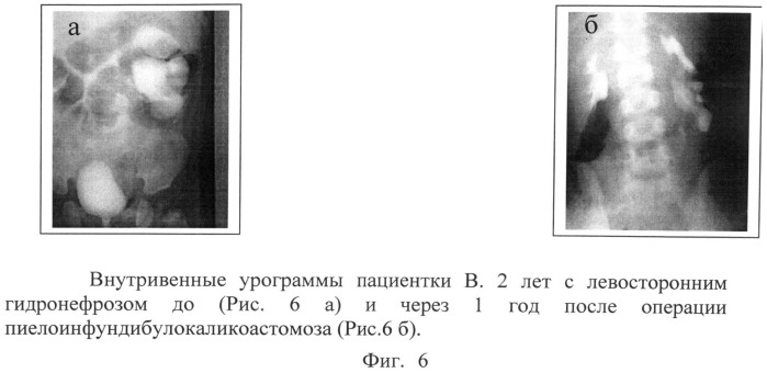 Способ лечения гидронефроза у детей (патент 2495630)