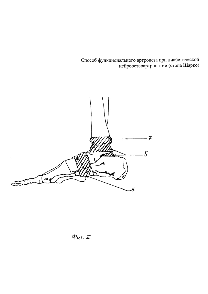 Способ функционального артродеза при диабетической нейроостеоартропатии (стопа шарко) (патент 2604383)