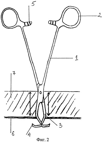 Хирургический инструмент для поднятия апоневроза при ушивании постлапароскопических троакарных ран (патент 2499566)