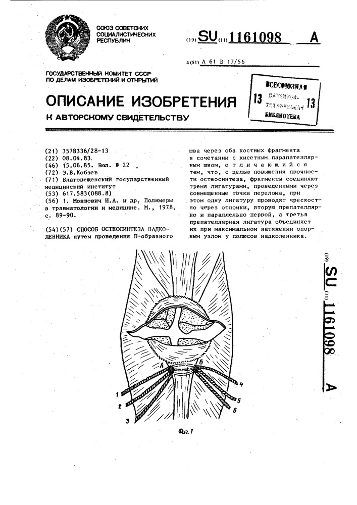 Способ остеосинтеза надколенника (патент 1161098)