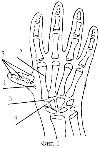 Способ лечения врожденной гипоплазии первого пальца кисти (патент 2297190)