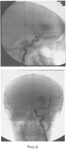 Способ лечения артериовенозных мальформаций головного мозга (патент 2534233)