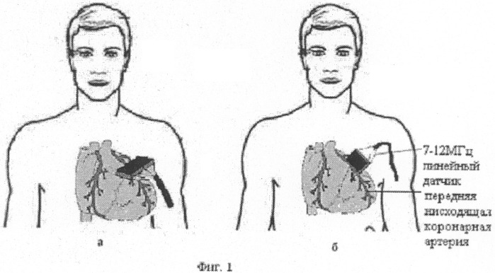 Способ оценки коронарного резерва миокарда левого желудочка (патент 2326598)