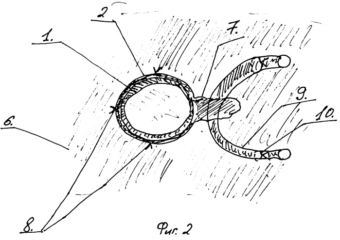 Способ формирования илеостомы (патент 2320278)