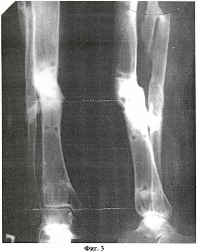 Способ лечения длительносрастающихся, несросшихся переломов и ложных суставов длинных костей (патент 2406462)