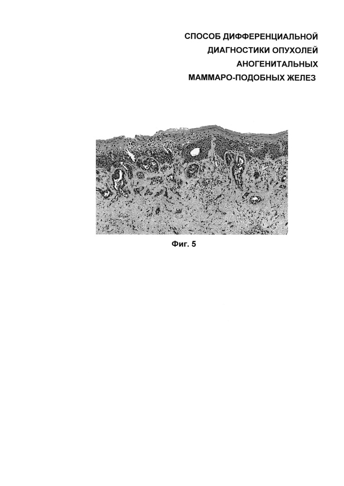 Способ дифференциальной диагностики опухолей аногенитальных маммароподобных желез (патент 2626123)