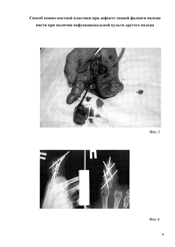 Способ кожно-костной пластики при дефекте тканей фаланги пальца кисти при наличии нефункциональной культи другого пальца (патент 2586311)