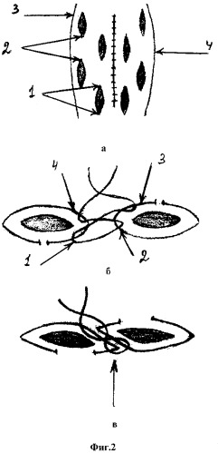 Способ пластики брюшной стенки при больших вентральных грыжах (патент 2299694)
